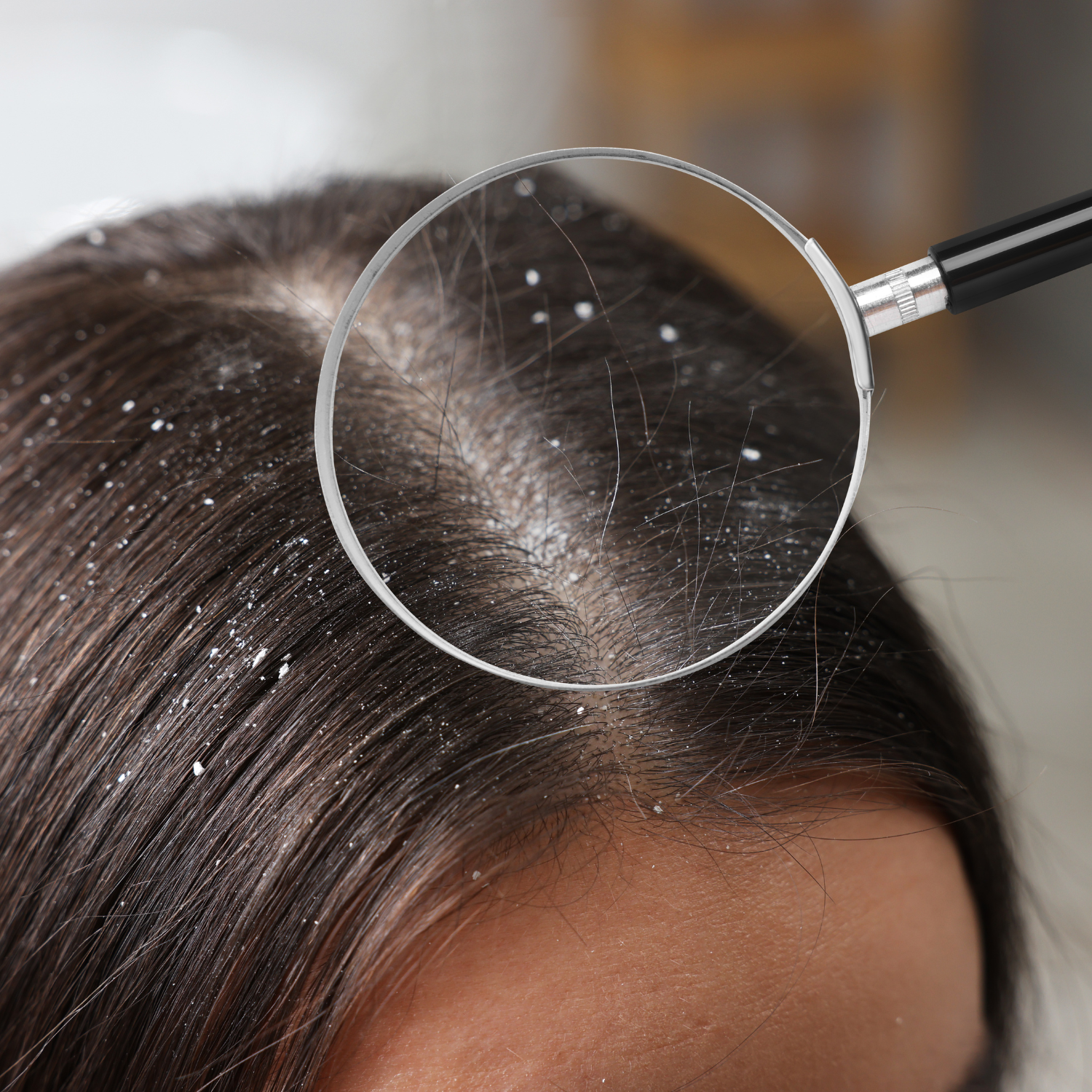 How To Get Rid Of Dandruff (Even With Extensions In)